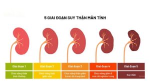 Dấu hiệu suy thận ở các giai đoạn