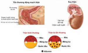 Dấu hiệu suy thận ở người lớn và trẻ em 1