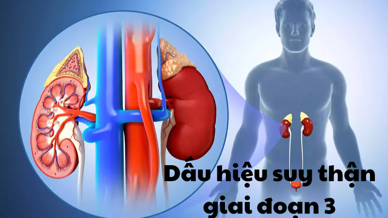 dấu hiệu suy thận giai đoạn 3